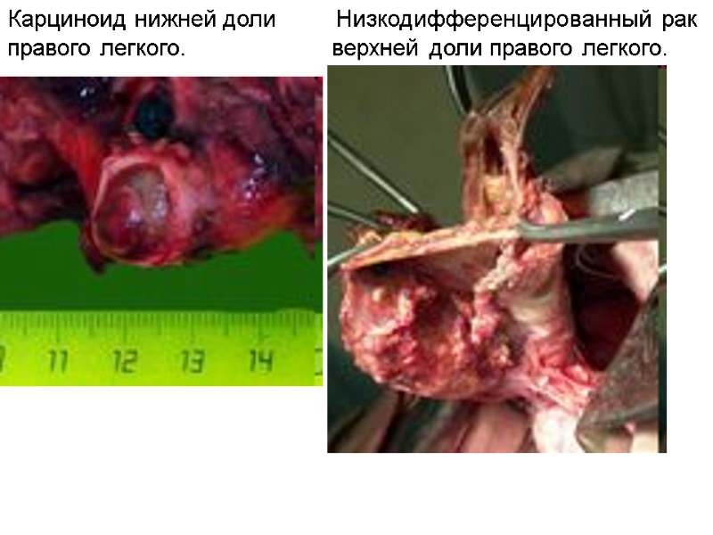Карциноид нижней доли         Низкодифференцированный рак правого